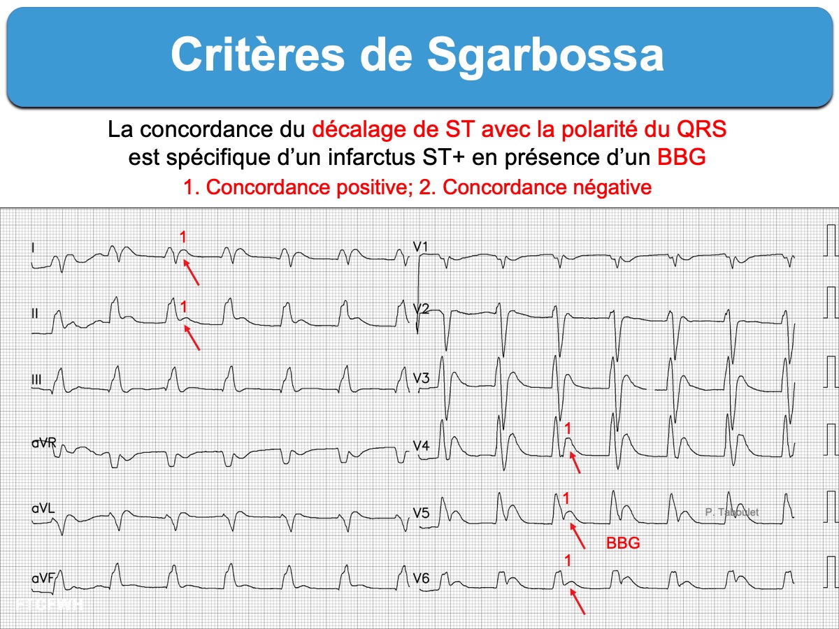 Critères de Sgarbossa — exemples tracés ECG concordance