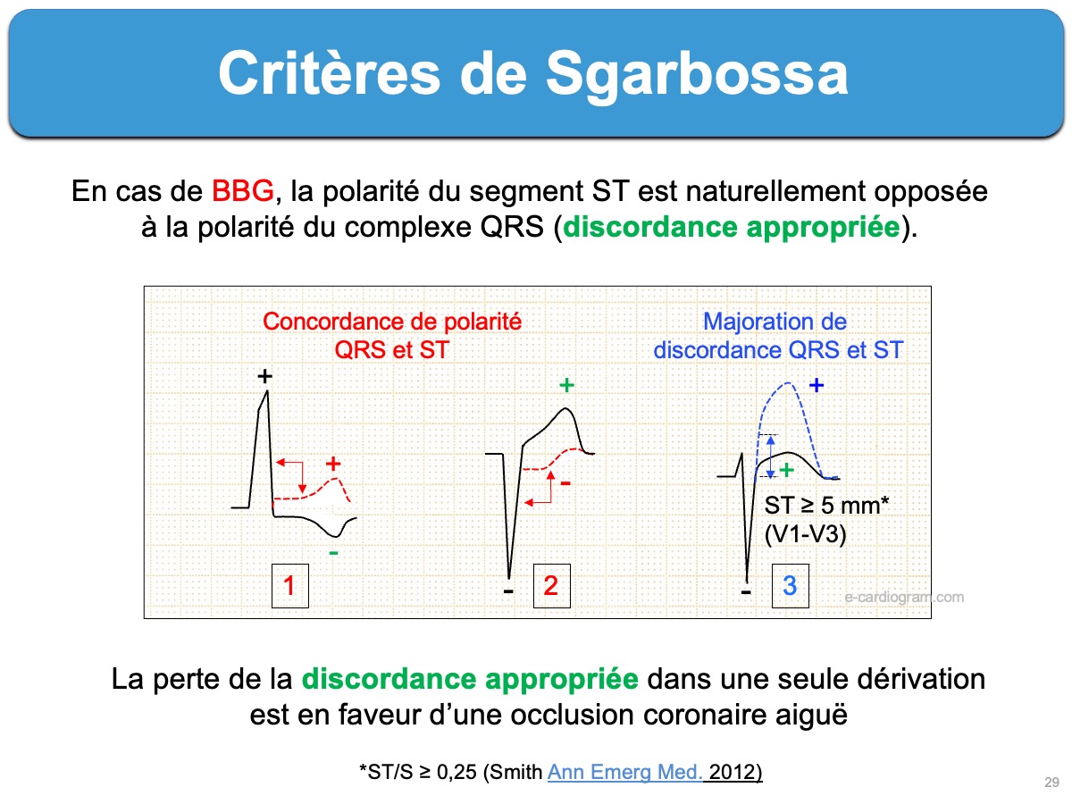 Critères de Sgarbossa — schéma ECG concordance et discordance