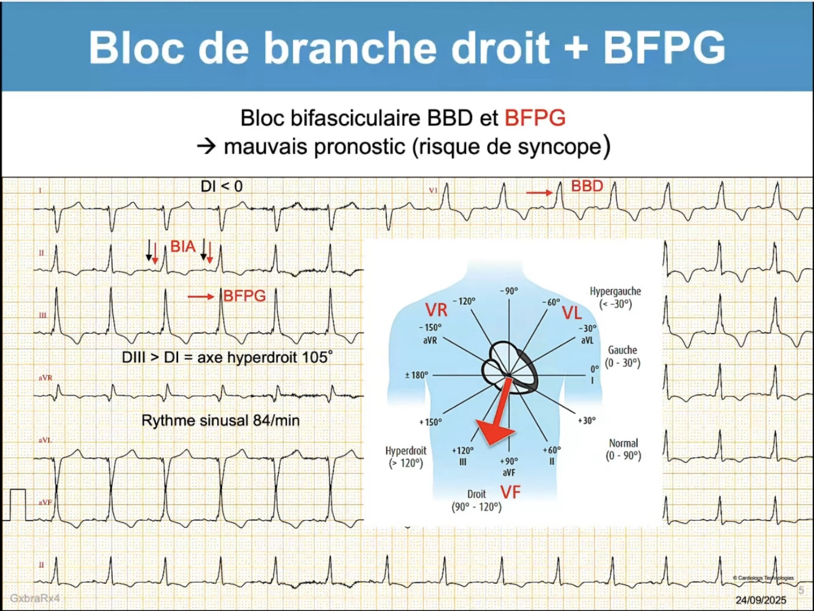BBD + BFPG — tracé 12 dérivations