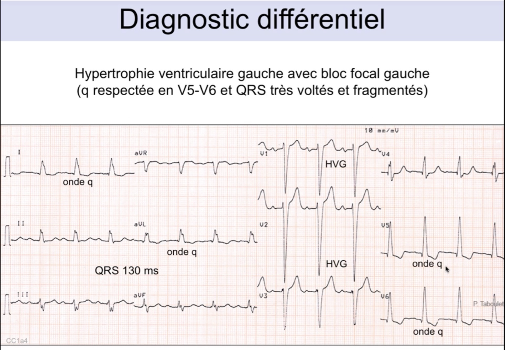 Diagnostic différentiel BBG vs HVG — onde q respectée en V5-V6 dans l'HVG, QRS 130ms, voltages élevés