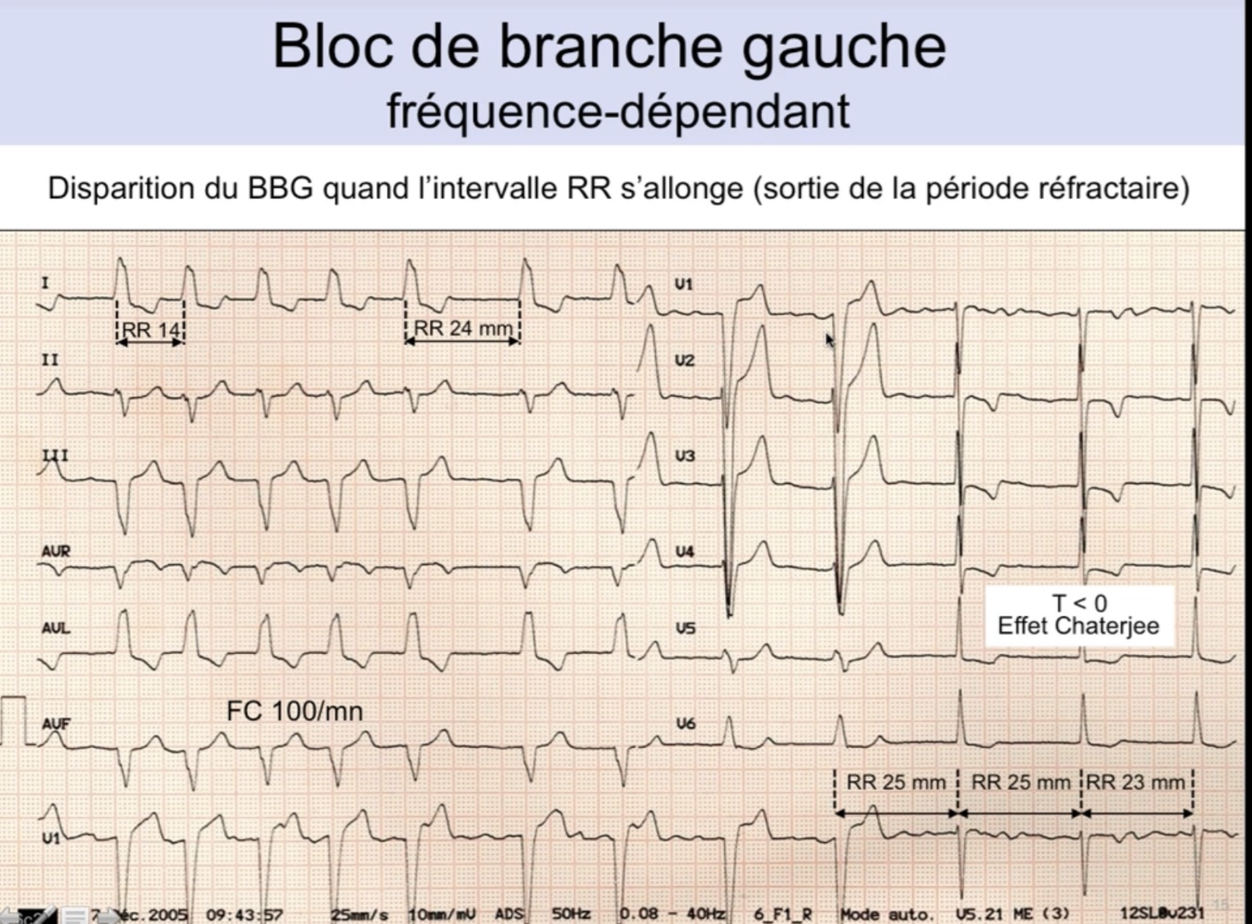 BBG fréquence-dépendant — disparition du BBG quand RR s'allonge, T négative résiduelle effet Chatterjee