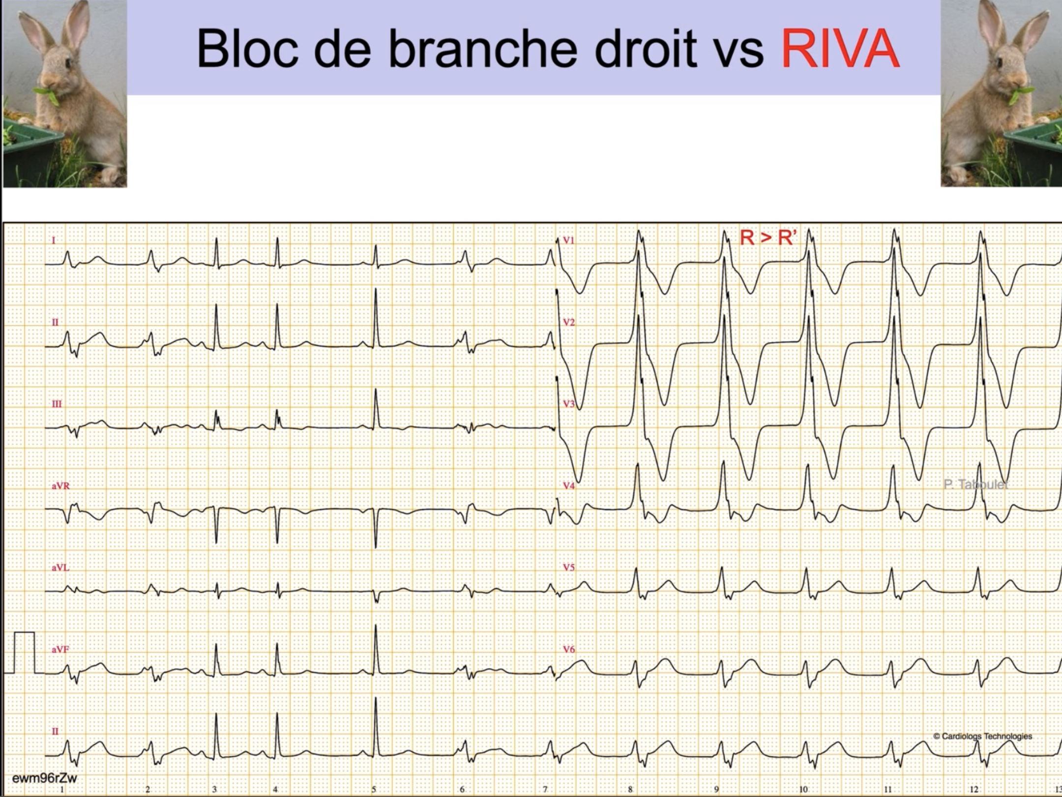 RIVA — transition sinusal vers ventriculaire
