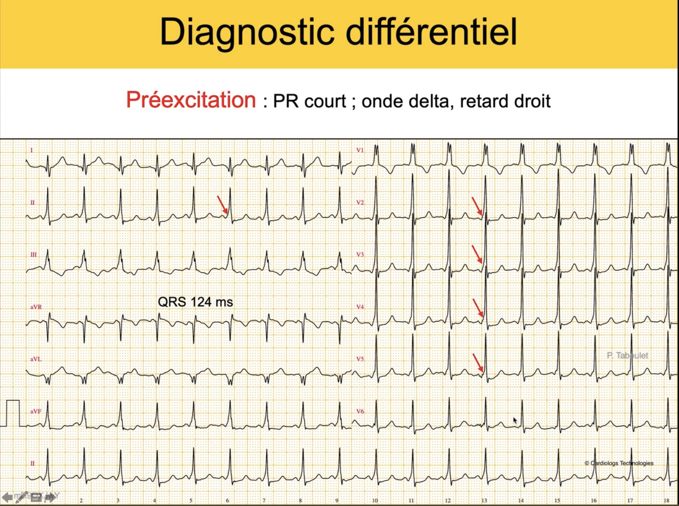 WPW — PR court, onde delta, QRS 124ms