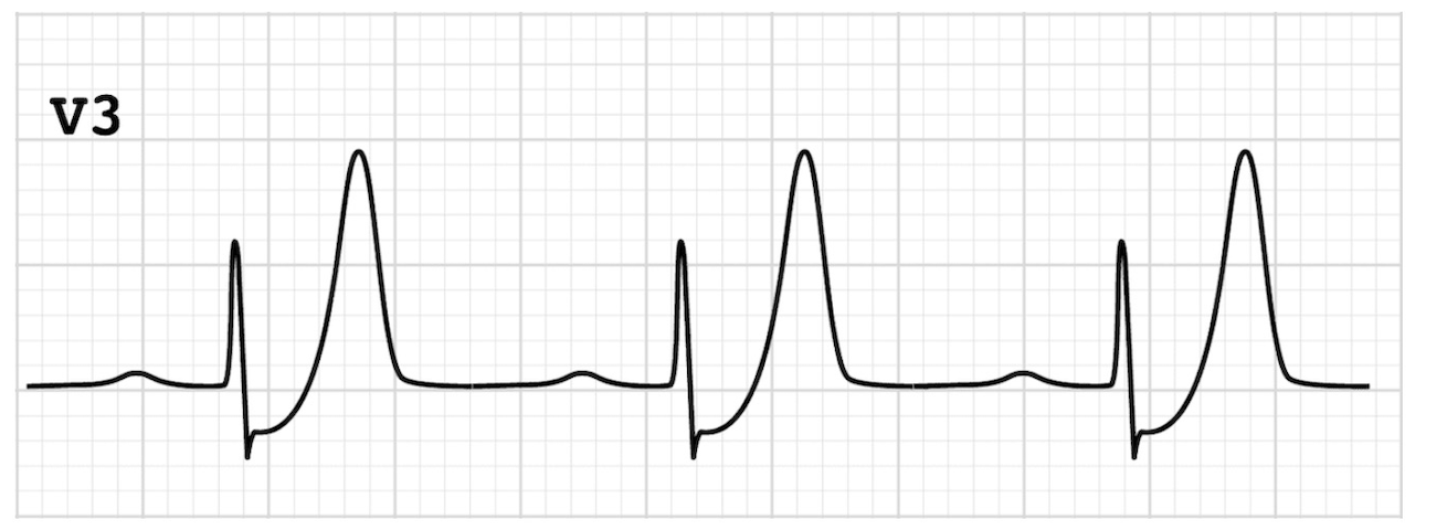 De Winter T waves — ST↓ ascendant + T pointues symétriques en V3, occlusion IVA proximale