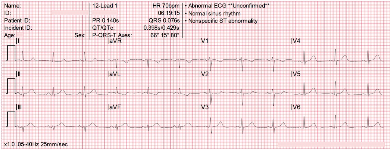 Ondes T hyperaiguës inférieures — T dépasse le QRS en DIII/aVF, ST↓ miroir V1-V3, machine dit nonspecific ST abnormality