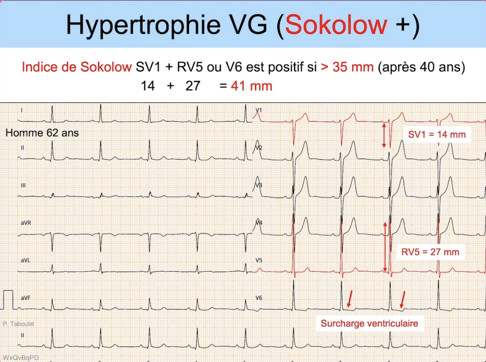 HVG — Sokolow positif SV1+RV5 = 41 mm, surcharge ventriculaire