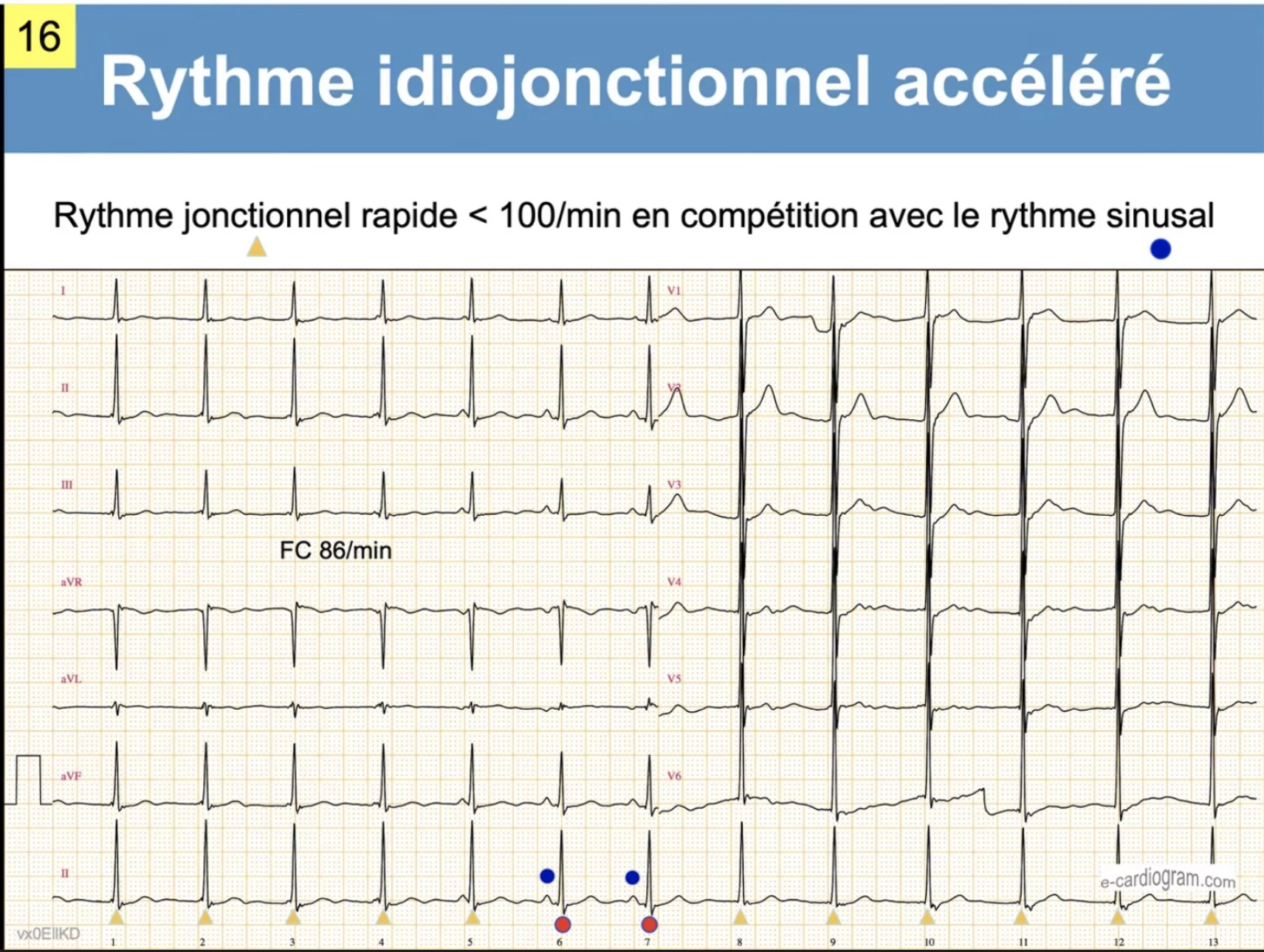 Rythme jonctionnel en compétition avec rythme sinusal
