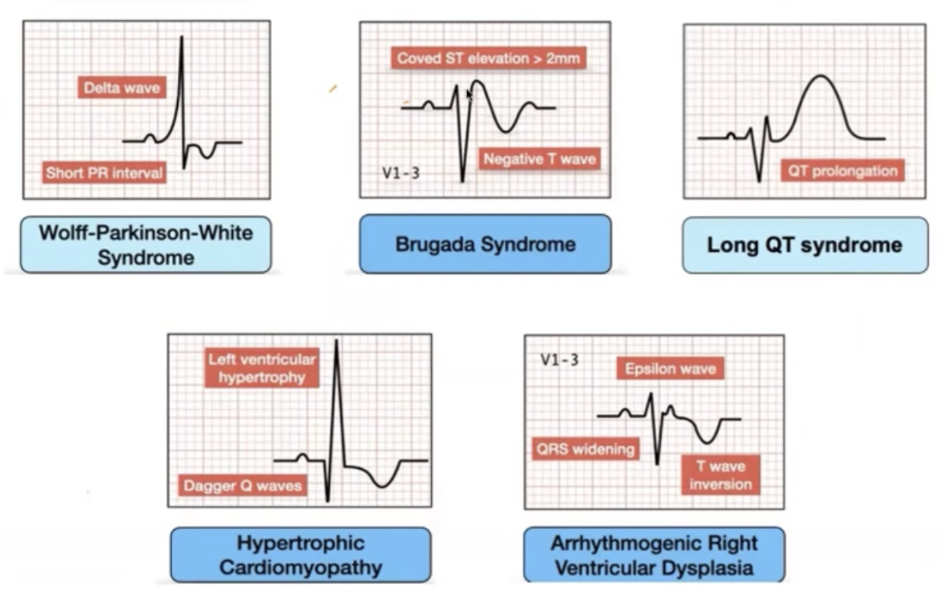 ECG Killers — WPW, Brugada, QT long, CMH, DAVD
