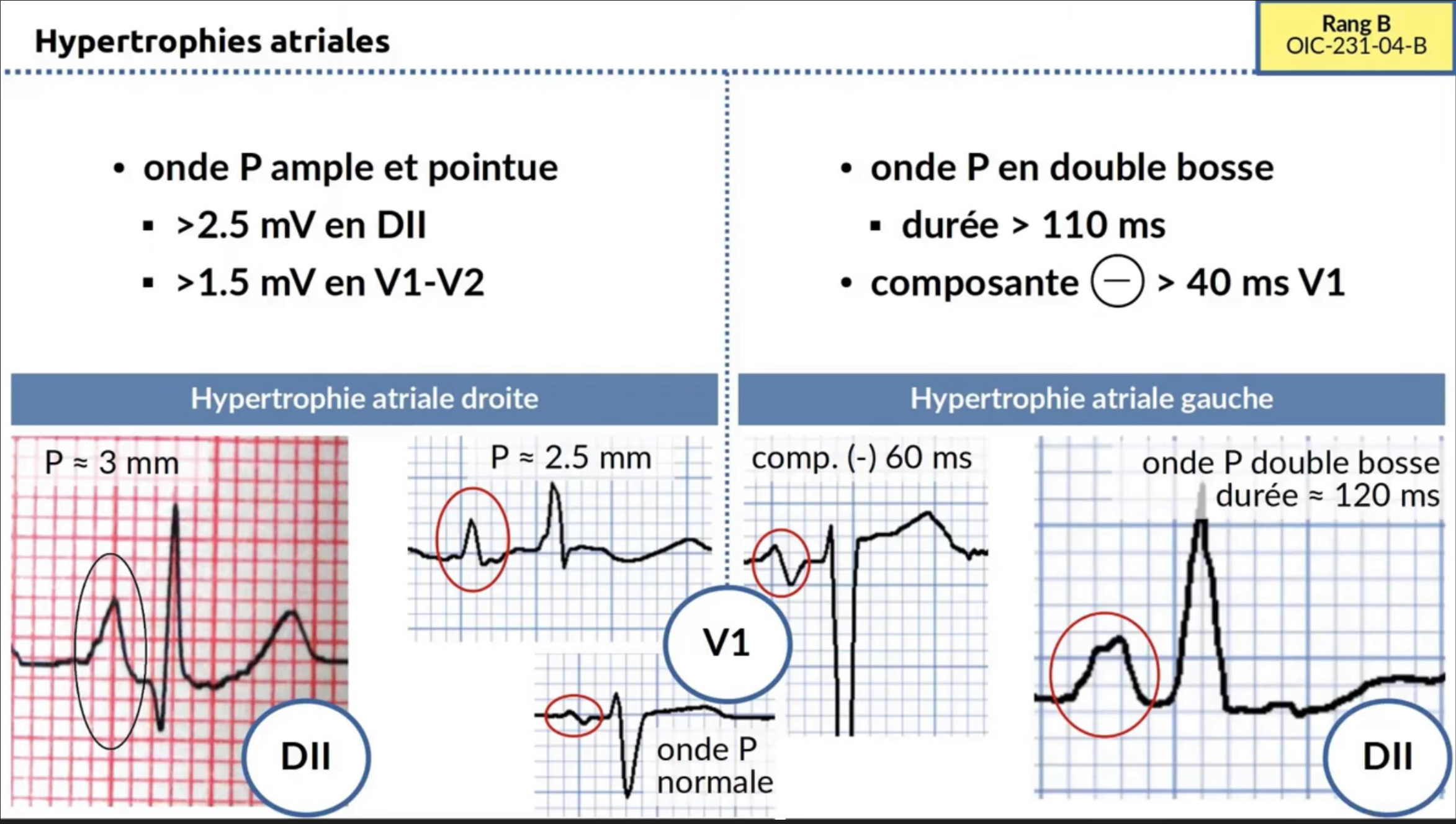 Hypertrophies atriales — tracés ECG HAD et HAG comparatifs