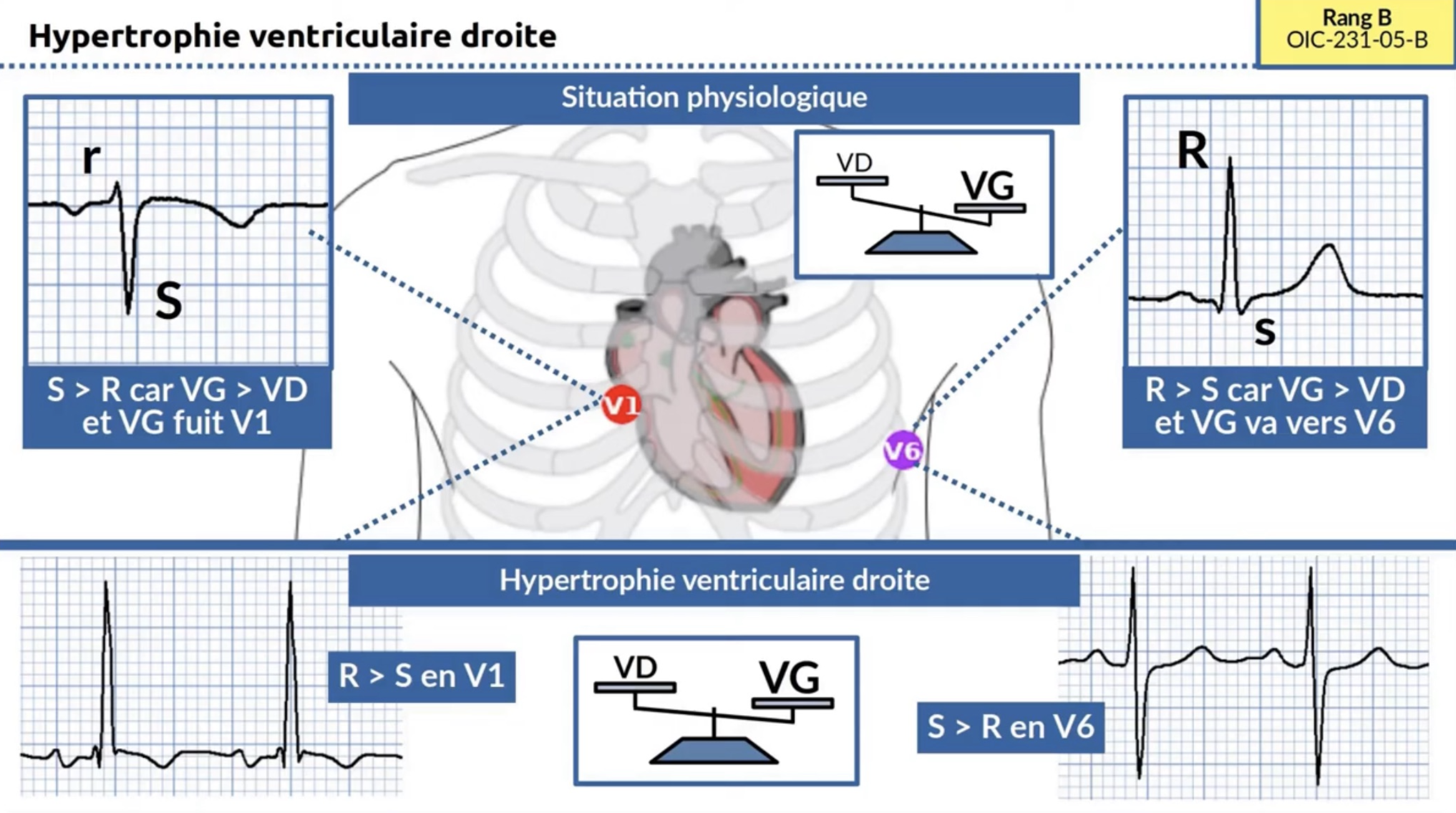HVD rationnel — R>S en V1, S>R en V6