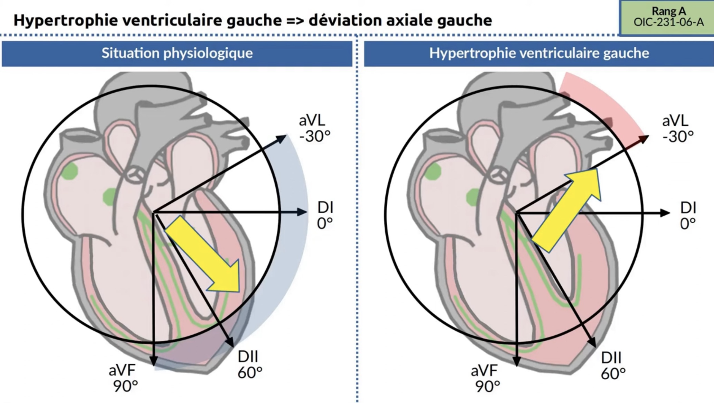 HVG — déviation axiale gauche