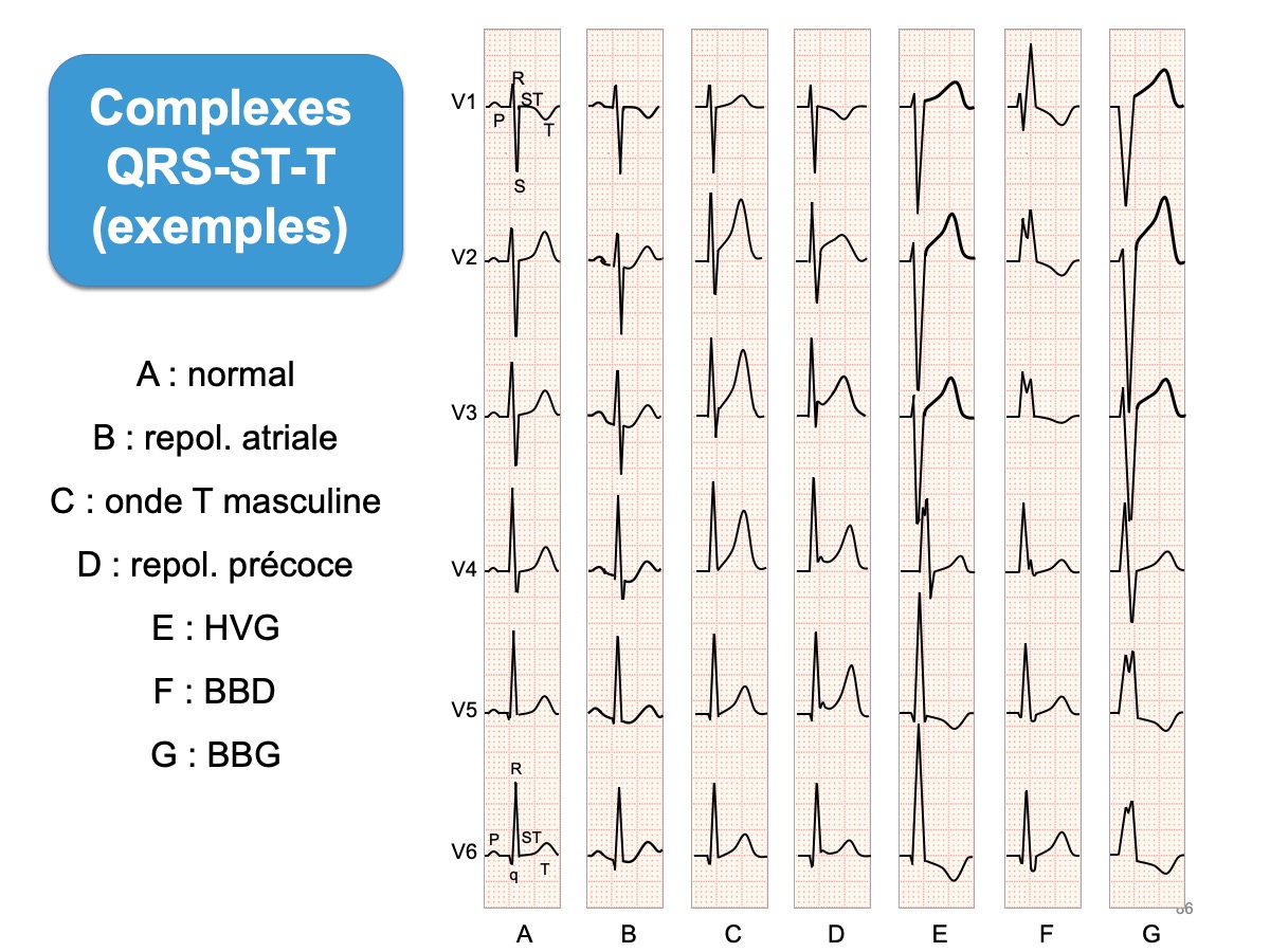 Synthèse complexes QRS-ST-T — normal, BBD, BBG, HVG, repolarisation précoce