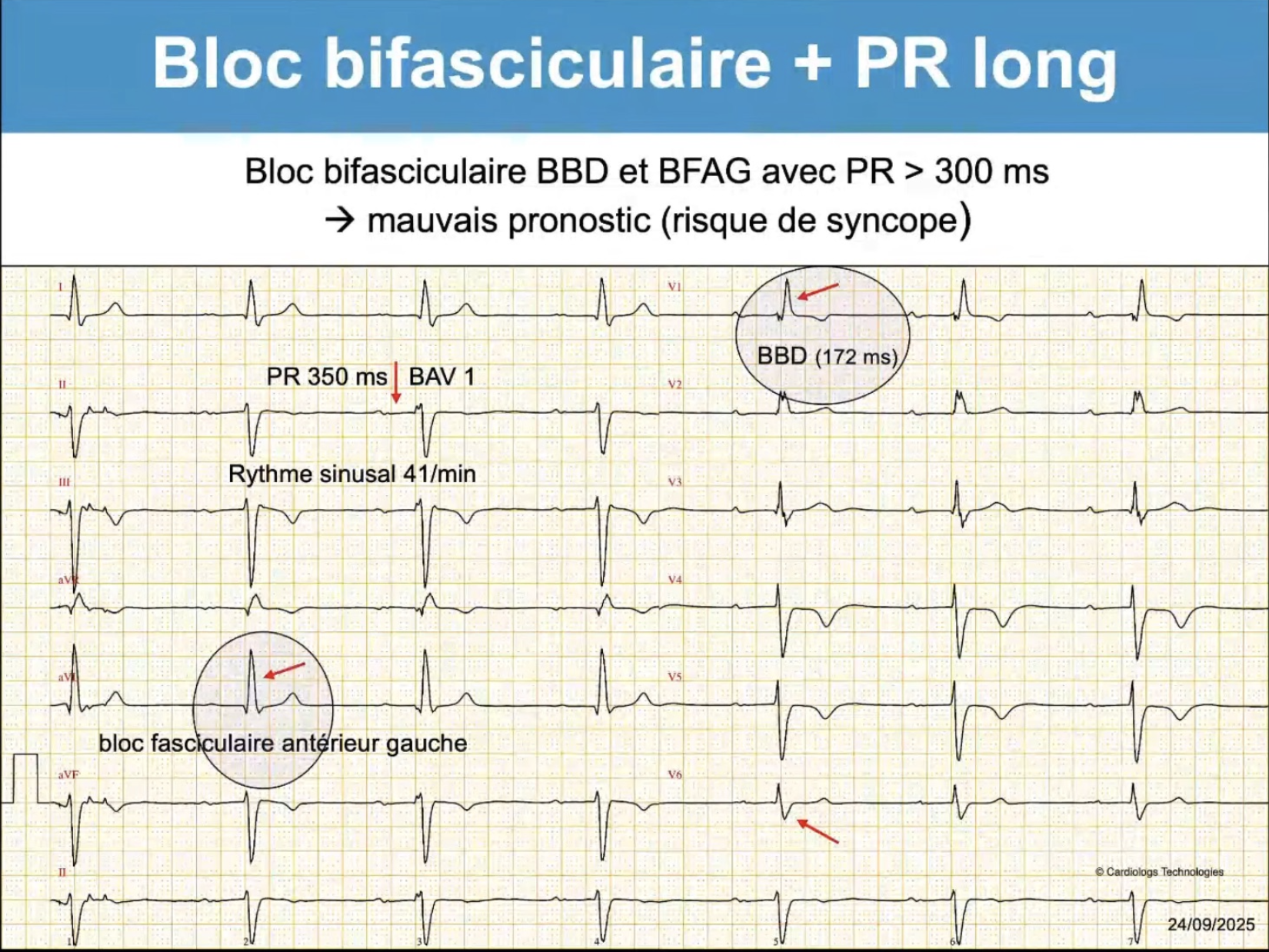 Bloc trifasciculaire — BBD + HBAG + PR 350ms